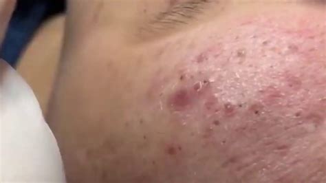 A gum pimple that is triggered by tooth or gum abscess also causes swelling to the cheeks or a face side wherein the infection occurs Pimples can be located both under the skin and. . 2021 infected root acne removal videos